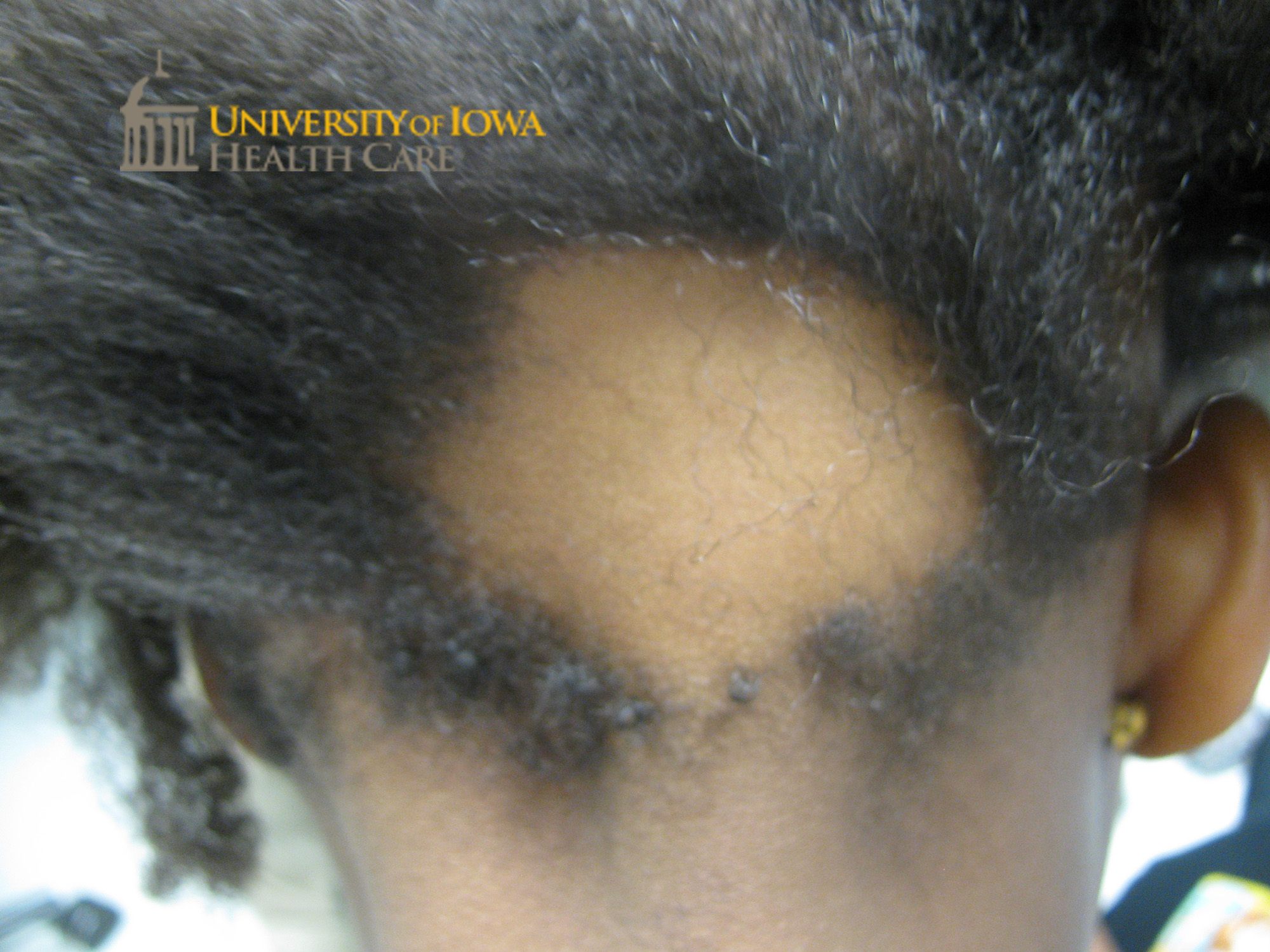 Multiple round patches of nonscarring alopecia on the scalp. (click images for higher resolution).